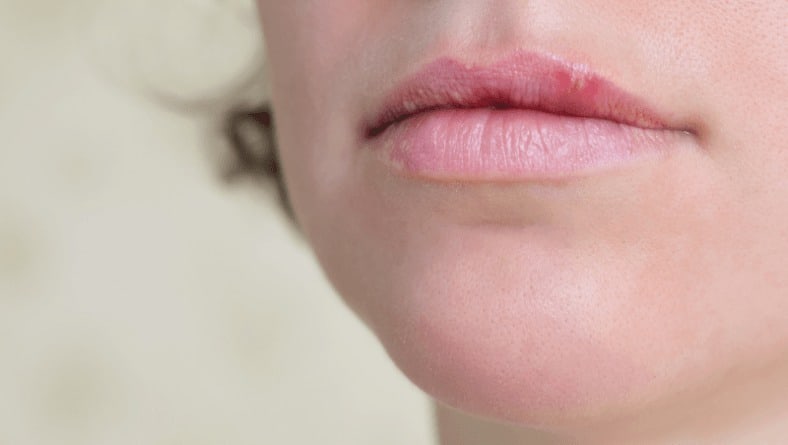 Херпес на устата – как да го предотвратим?