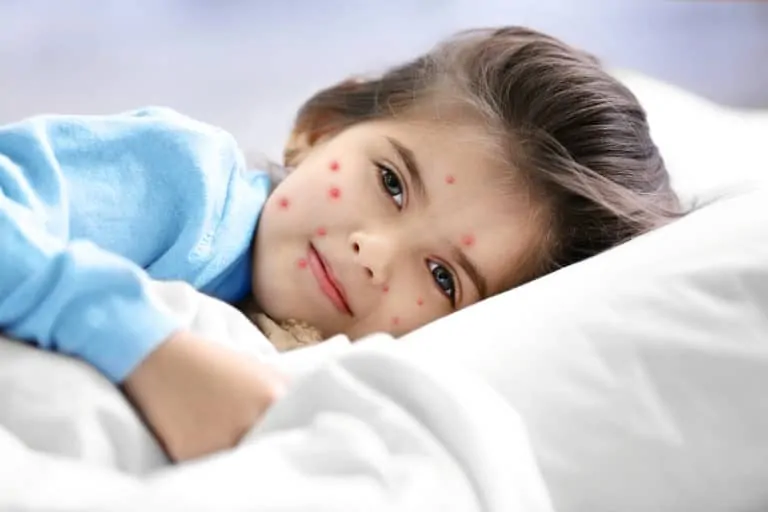 Заразяване с варицела – симптоми и природна профилактика