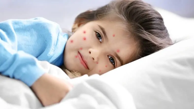 Заразяване с варицела – симптоми и природна профилактика