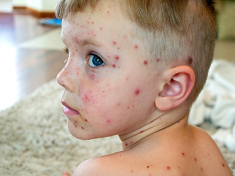 варицела при децата