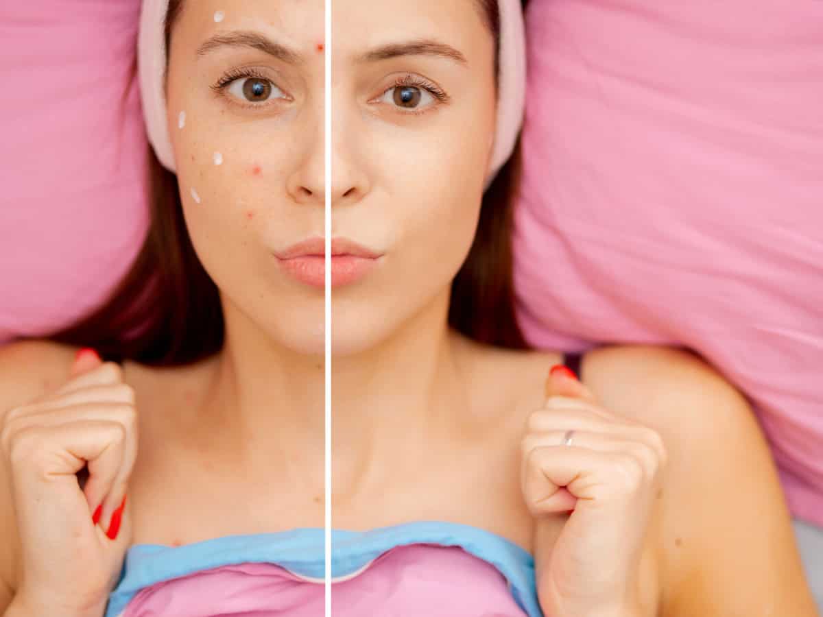 Варицела при възрастни